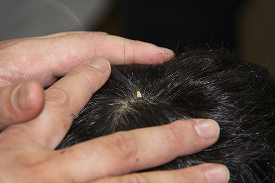 いぼ痔・切れ痔