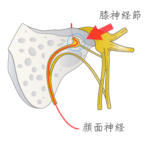 顔面神経麻痺の神経変性