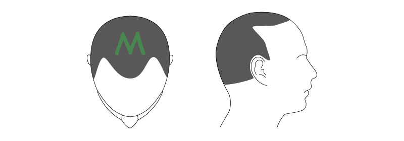 M字ベジータハゲ